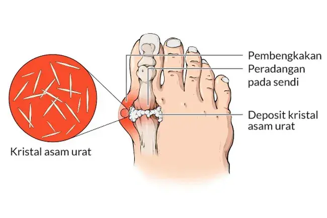 Pijat Reposisi Tulang Sendi